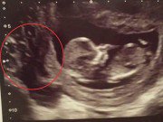 Bà bầu - Siêu âm thai 12 tuần, mẹ bầu khóc nức nở khi thấy nhau thai rỗ như tổ ong