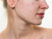 Đẹp - Tất tần tật những cách để đối phó với mụn, sẹo thâm mà nàng nào cũng phải biết!