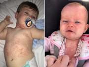 Làm mẹ - Hai bé trai nguy kịch vì mắc bệnh sởi nhưng bác sĩ chẩn đoán nhầm là cảm lạnh