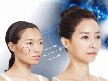 Phương pháp hạ xương gò má mới thực sự là cứu tinh của những nàng có gò má cao!