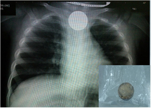 Cứu sống trẻ 18 tháng nuốt phải đồng xu - 1