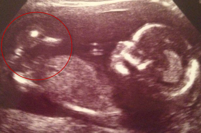 Một chú vịt bất ngờ xuất hiện trong hình ảnh siêu âm thai nhi.
