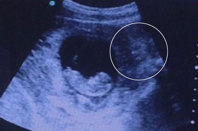 Bức ảnh siêu âm thai này đã thu hút hơn 500.000 lượt xem chỉ sau 1 ngày được đăng tải là bởi người ta đã phát hiện ra bên góc phải của bức ảnh là hình ảnh một con quỷ dữ. Không ít người đã bình luận họ cảm thấy thực sự lo lắng và không thể giải thích tại sao lại có hình ảnh đó.

