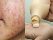 Làm đẹp - Da sẽ bị mẩn đỏ, căng rát nếu bạn tiếp tục để 6 thứ này chạm vào mặt