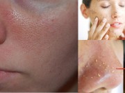 Làm đẹp - Liệt kê 5 cách nhất định phải biết thu nhỏ lỗ chân lông khít khìn khịt