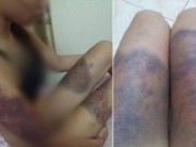 Tin tức - Cô gái trẻ bị bạn trai hành hạ thâm tím khắp người vì ghen tuông