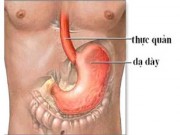 Sức khỏe - Trào ngược dạ dày thực quản dễ dẫn đến ung thư