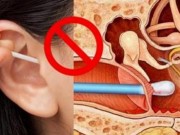 Sức khỏe - Clip cho thấy, việc lấy ráy tai bằng tăm bông nguy hiểm thế nào