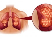 Sức khỏe - Dấu hiệu ung thư phổi bạn cần biết, ngay cả khi bạn không hút thuốc