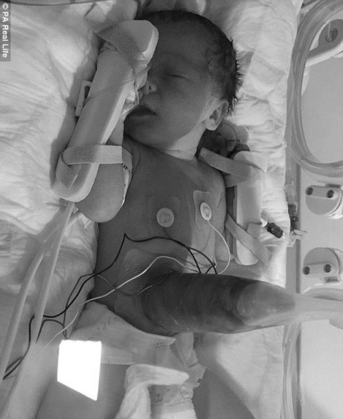 Sinh ra với amp;#34;ruột để ngoài daamp;#34; nhưng em bé này đã lớn lên đáng yêu không ngờ - 2