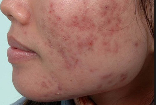 Gột sạch mụn cùng vết thâm nhờ nước dừa pha cùng mật ong - 1