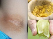 Làm đẹp - Chỉ cần dùng gừng kết hợp với các nguyên liệu sau sẽ trị thâm nách cực hiệu quả