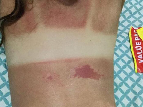 Mẹ bôi kem chống nắng cho con đi biển, bé gái 5 tuổi gánh hậu quả nặng nề - 2