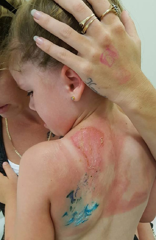 Mẹ bôi kem chống nắng cho con đi biển, bé gái 5 tuổi gánh hậu quả nặng nề - 1