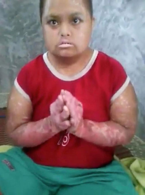 Chỉ vì muỗi đốt, bé gái suốt 2 năm không đi lại được - 1