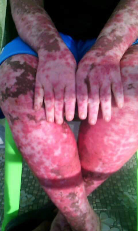 Chỉ vì muỗi đốt, bé gái suốt 2 năm không đi lại được - 2