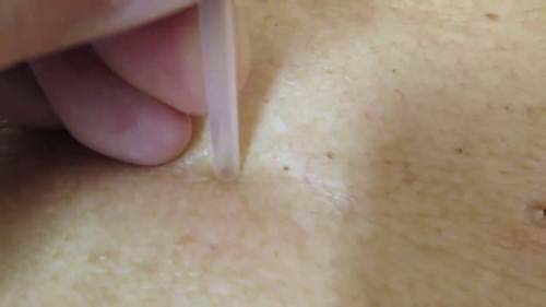 Chỉ 1 chiếc ruột bút bi, mụn đầu đen cứng đầu đến đâu cũng chui ra hết đến đấy - 4