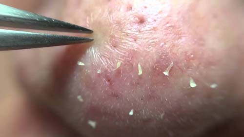 Chỉ 1 chiếc ruột bút bi, mụn đầu đen cứng đầu đến đâu cũng chui ra hết đến đấy - 5