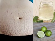 Làm đẹp - Rạn da chằng chịt sau sinh cũng được san phẳng với công thức siêu rẻ này
