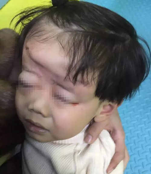 Mẹ mải xem điện thoại, con 4 tuổi bị xe đạp điện trong khu vui chơi cán qua đầu biến dạng - 1