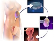 Chuẩn bị mang thai - Quy trình thụ tinh trong ống nghiệm mẹ hiếm muộn cần biết