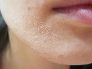 Làm đẹp - Giải pháp nào giúp ích làn da khô nẻ trong mùa lạnh