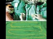 Tin tức - Bác sĩ kéo sán dây 1,8 m ra khỏi miệng bệnh nhân