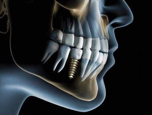 Như thế nào là nha khoa cấy ghép răng Implant tốt? - 1