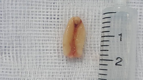 Tưởng con viêm phế quản, không ngờ nội soi phát hiện hạt lạc nằm trong đường thở - 1