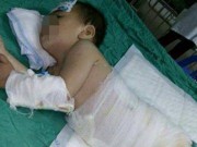 Tin tức - Bé 18 tháng tuổi bị ngã vào nồi canh, có nguy cơ hỏng bộ phận sinh sản