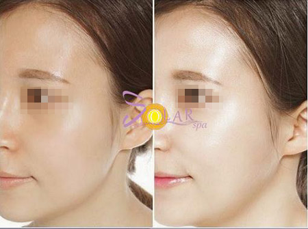 Làn da tươi trẻ, căng mượt nhờ phun trắng Double Baby Skin - 2