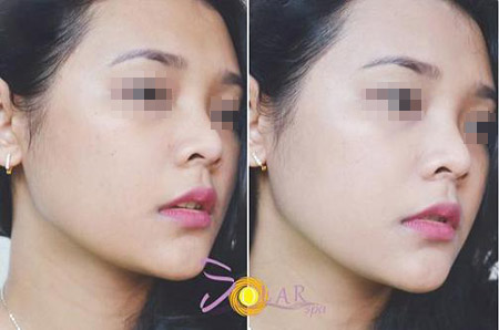 Làn da tươi trẻ, căng mượt nhờ phun trắng Double Baby Skin - 3