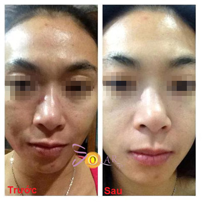 Làn da tươi trẻ, căng mượt nhờ phun trắng Double Baby Skin - 4