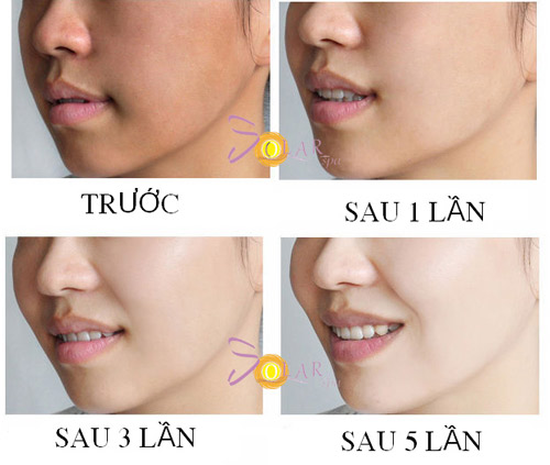 Làn da tươi trẻ, căng mượt nhờ phun trắng Double Baby Skin - 5