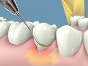 Sức khỏe - Mẹo hay trị viêm lợi, chảy máu chân răng hiệu quả không cần dùng thuốc