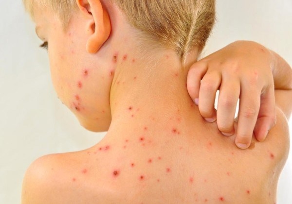 Bố mẹ nhầm thủy đậu với bệnh sởi, nhiều trẻ nguy kịch - 1