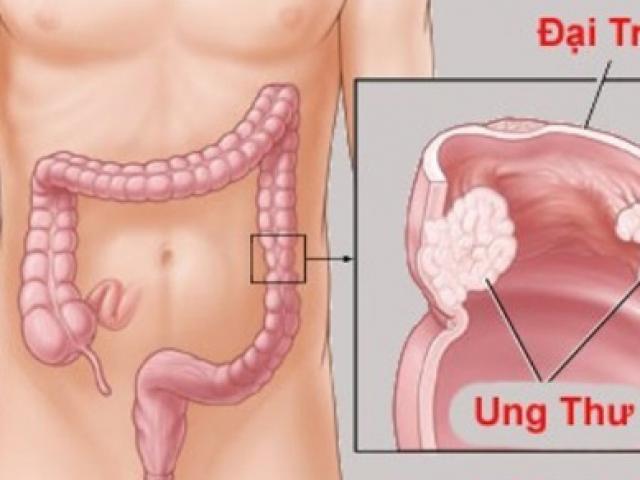 Tuyệt đối tránh xa 6 thực phẩm này nếu bạn không muốn bị ung thư đại tràng