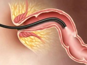 Sức khỏe - Bệnh polyp trực tràng là gì, có nguy hiểm không?