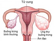 Sức khỏe - 10 dấu hiệu ung thư buồng trứng cực kì nguy hiểm