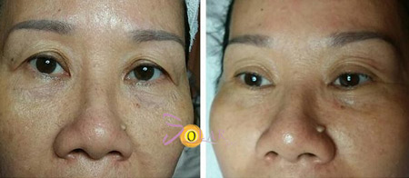 Giải pháp xóa nhăn đuôi mắt, nâng cơ mí sụp xệ trong 1 lần duy nhất - 1