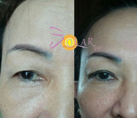 Giải pháp xóa nhăn đuôi mắt, nâng cơ mí sụp xệ trong 1 lần duy nhất - 2