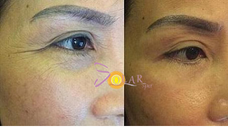 Giải pháp xóa nhăn đuôi mắt, nâng cơ mí sụp xệ trong 1 lần duy nhất - 3