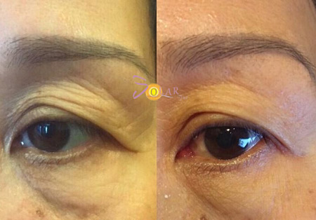 Giải pháp xóa nhăn đuôi mắt, nâng cơ mí sụp xệ trong 1 lần duy nhất - 4