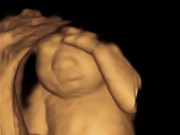 Bà bầu - Thai nhi dị tật, mẹ vẫn quyết giữ trong bụng để làm việc không ai ngờ này