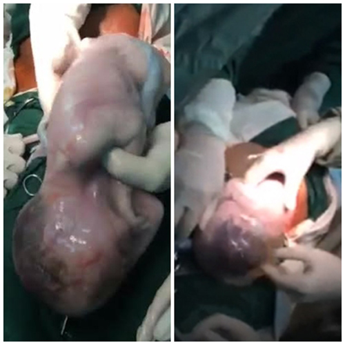 3 ca sinh con nằm trong bọc ối hy hữu tại Việt Nam khiến bác sĩ ngỡ ngàng - 1