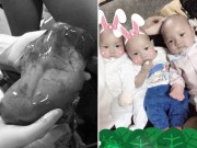 Bà bầu - 3 ca sinh con nằm trong bọc ối hy hữu tại Việt Nam khiến bác sĩ ngỡ ngàng