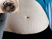 Làm đẹp - Rạn đỏ, rạn trắng dù lâu hay mới cũng mờ nhanh nhờ thoa hỗn hợp này mỗi ngày