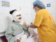 Tin tức - 2 cô gái trẻ tổn thương nặng vùng mặt do nổ bóng bay