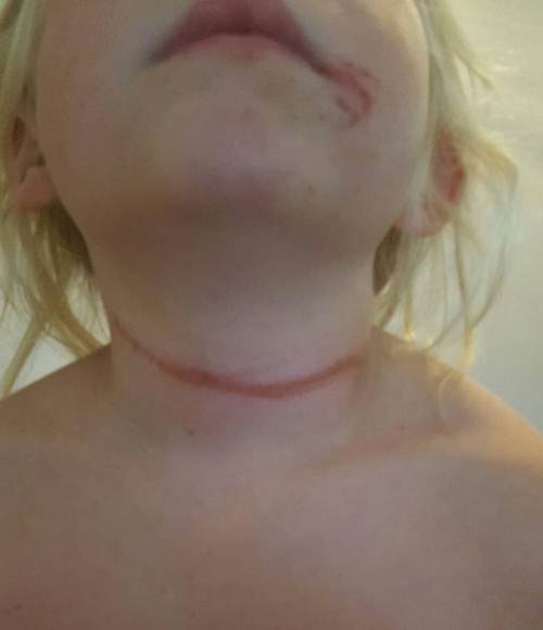 Chỉ vì chiếc dây quai mũ bé gái 6 tuổi bị siết cổ gần nghẹt thở