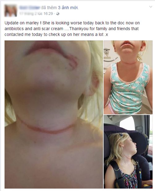 Chỉ vì chiếc dây quai mũ bé gái 6 tuổi bị siết cổ gần nghẹt thở